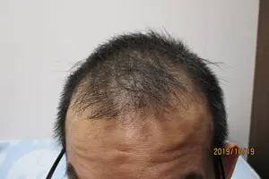 前頭部の症例写真、内服開始前