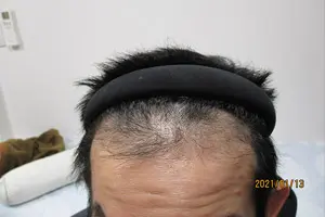 前頭部の症例写真内服1年3か月後