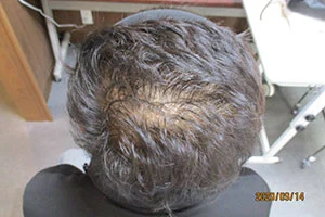 AGAの治療実績症例写真内服開始前