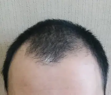 AGAのタイプ　M字型