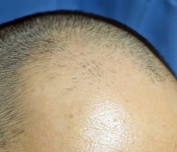 男性型脱毛症のU字型の症例写真