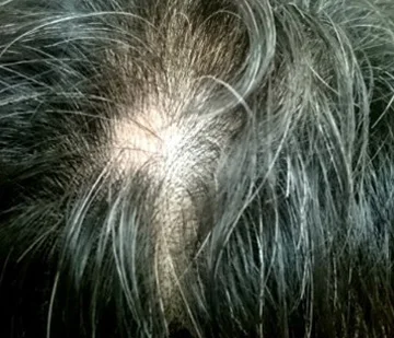 男性型脱毛症のO字型の症例写真
