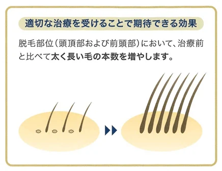 適切なAGA治療を受けることで来たいできる効果